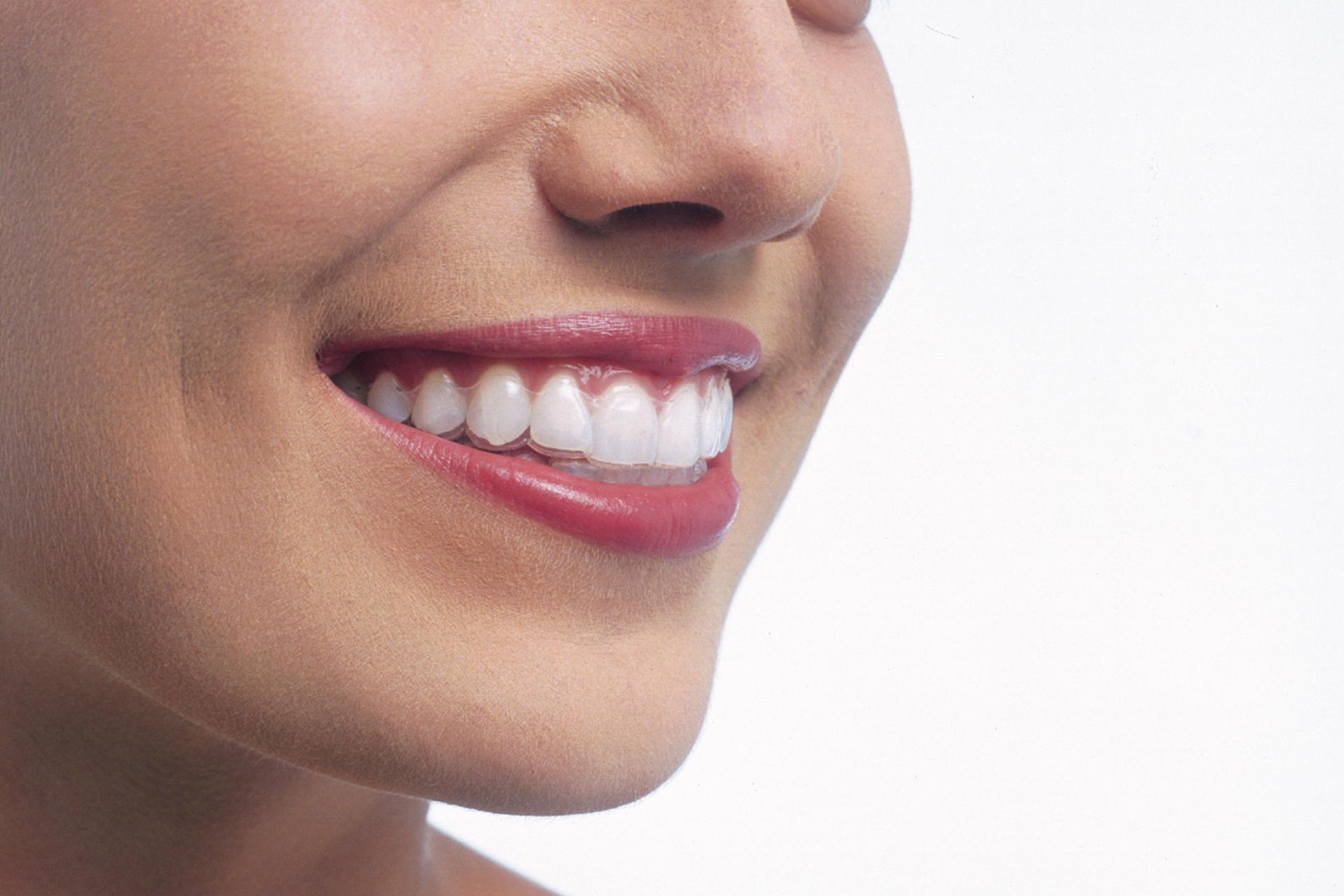 Aligner-System Invisalign